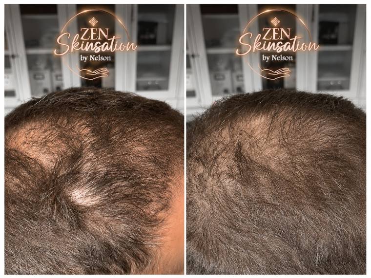 PRP hair growth result at Zenskinsation