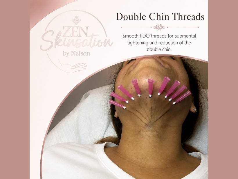 Double Chin PDO Threads at Zenskinsation