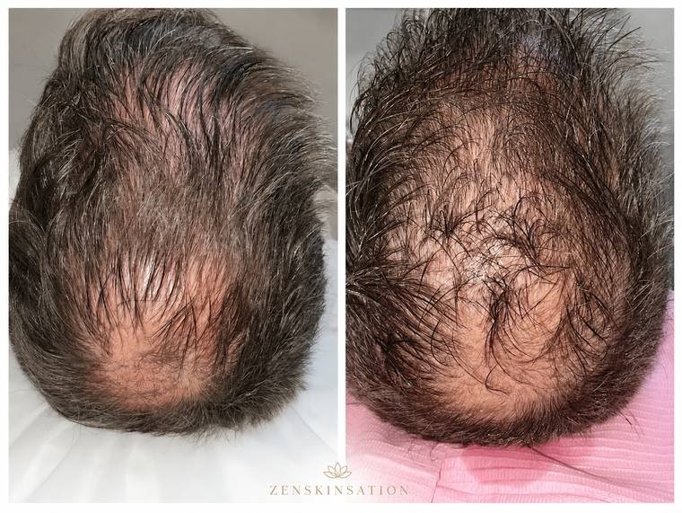 PRP hair growth result at Zenskinsation