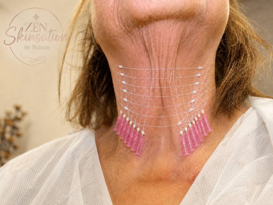 PDO thread placement on the neck at Zenskinsation