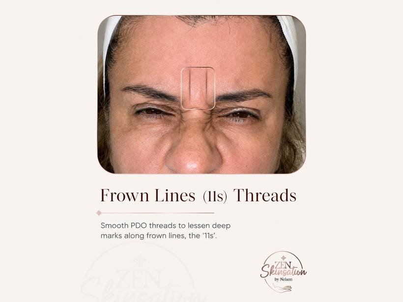 Frown lines treatment planning at Zenskinsation