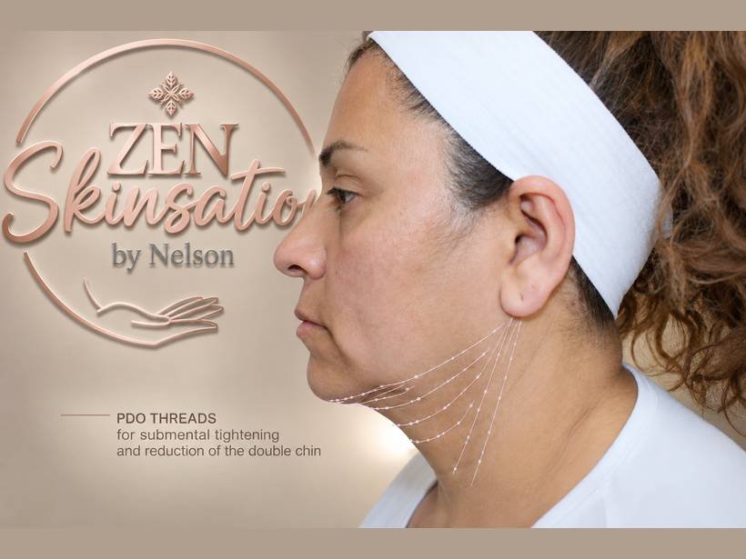 Submental PDO thread treatment at Zenskinsation