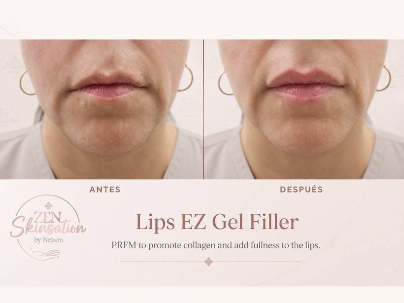Lips EZ Gel Filler before and after at Zenskinsation