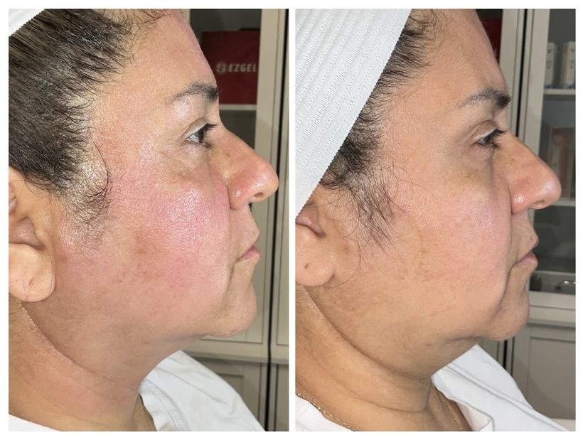 Before and after result — Zenskinsation