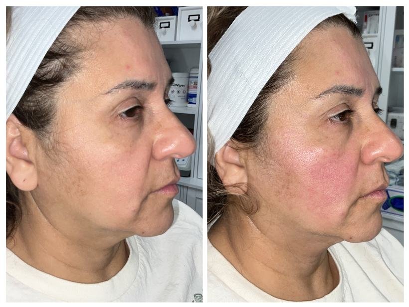 Before and after result — Zenskinsation