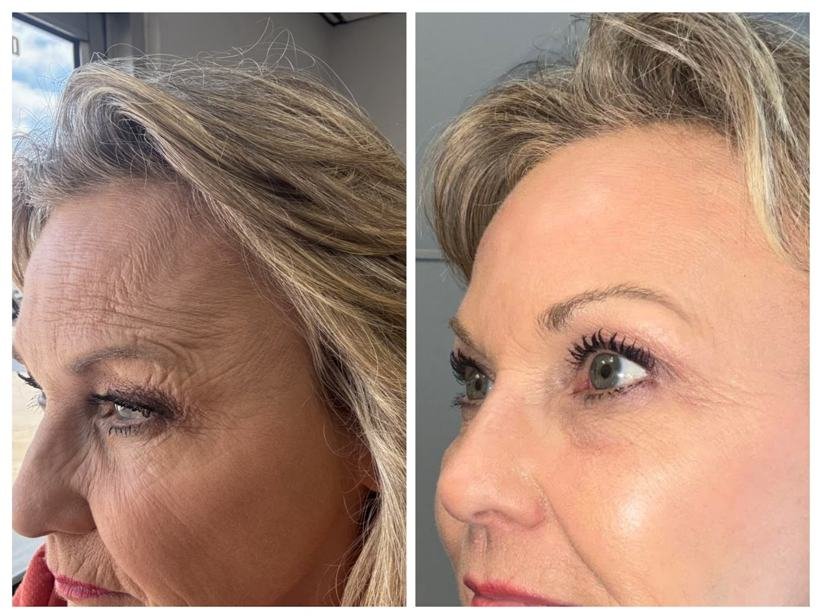 Before and after result — Zenskinsation