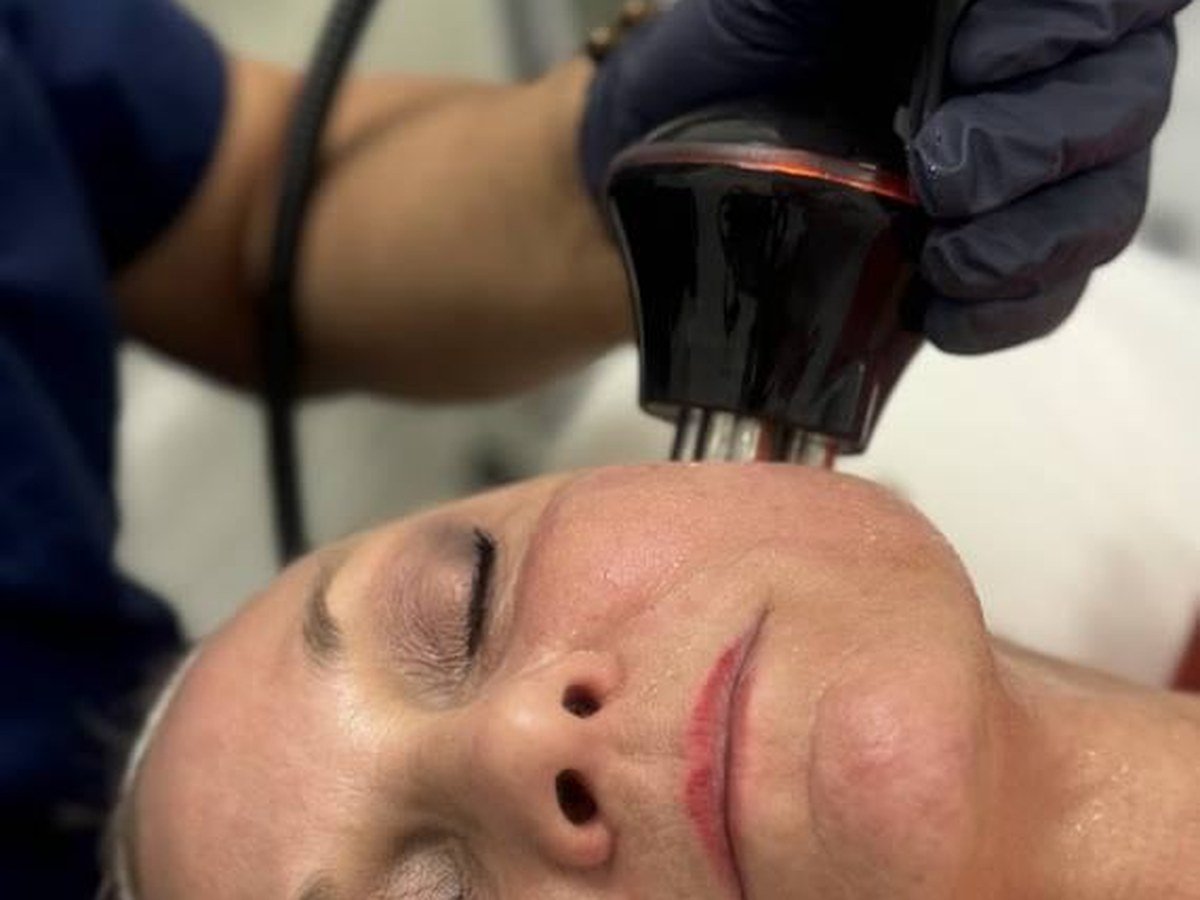 TriLift®: el lifting facial sin cirugía, explicado